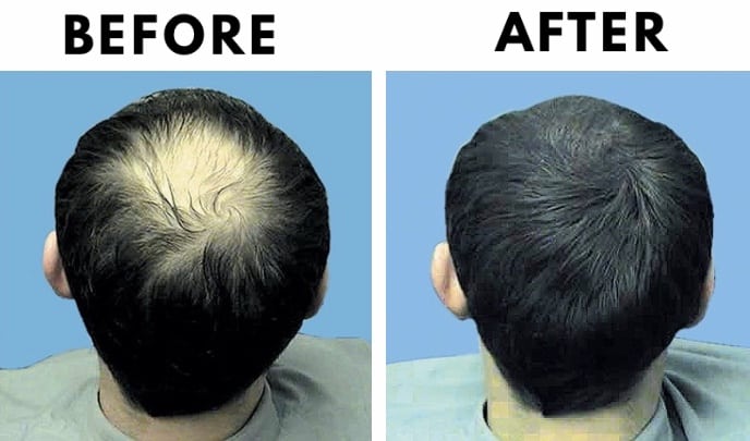 How to Stop Hair Loss? Tips to Stop Hair Loss